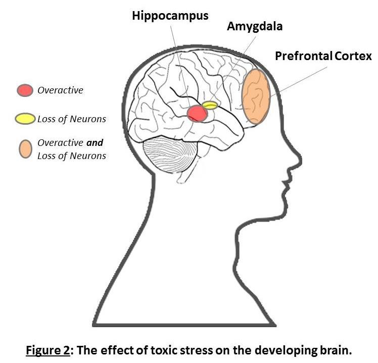 Figure 2: The effect of toxic stress on the developing brain. Hippocampus = Overactive. Amygdala = Loss of neurons. Prefrontal cortex = Overactive and loss of neurons.