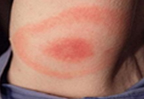 A person’s upper arm shows a red patch at the site of the tick bite, inside a larger red ring.
